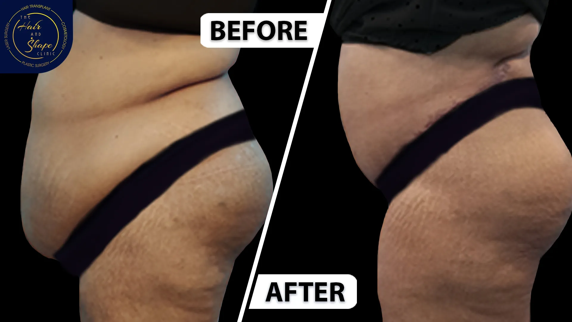 Tummy Tuck result7